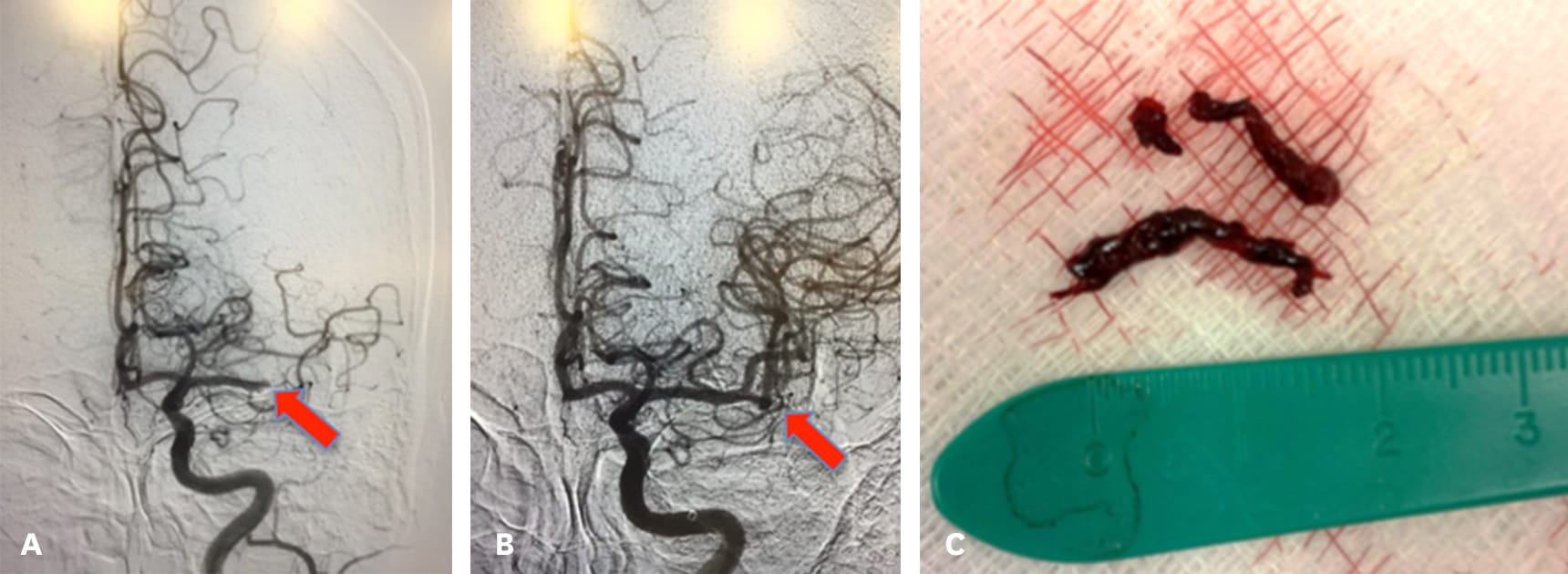 Figure 4 – For patients with mismatch between core infarction and penumbra (see Figure 3), mechanical thrombectomy can restore blood flow and improve neurological outcome. (a) Angiogram pre-thrombectomy. Note abrupt cutoff at arrow. (b) Angiogram post-thrombectomy. Arrow denotes restored blood flow. (c) Thrombus removed from vessel.