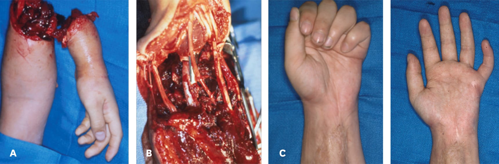 A 12-year-old patient with (a) sustained sub-total amputation of his left forearm. (b) Revascularization and repair with internal fixation. (c) Free muscle flap covering the soft tissue defect on the anterior side of the forearm.