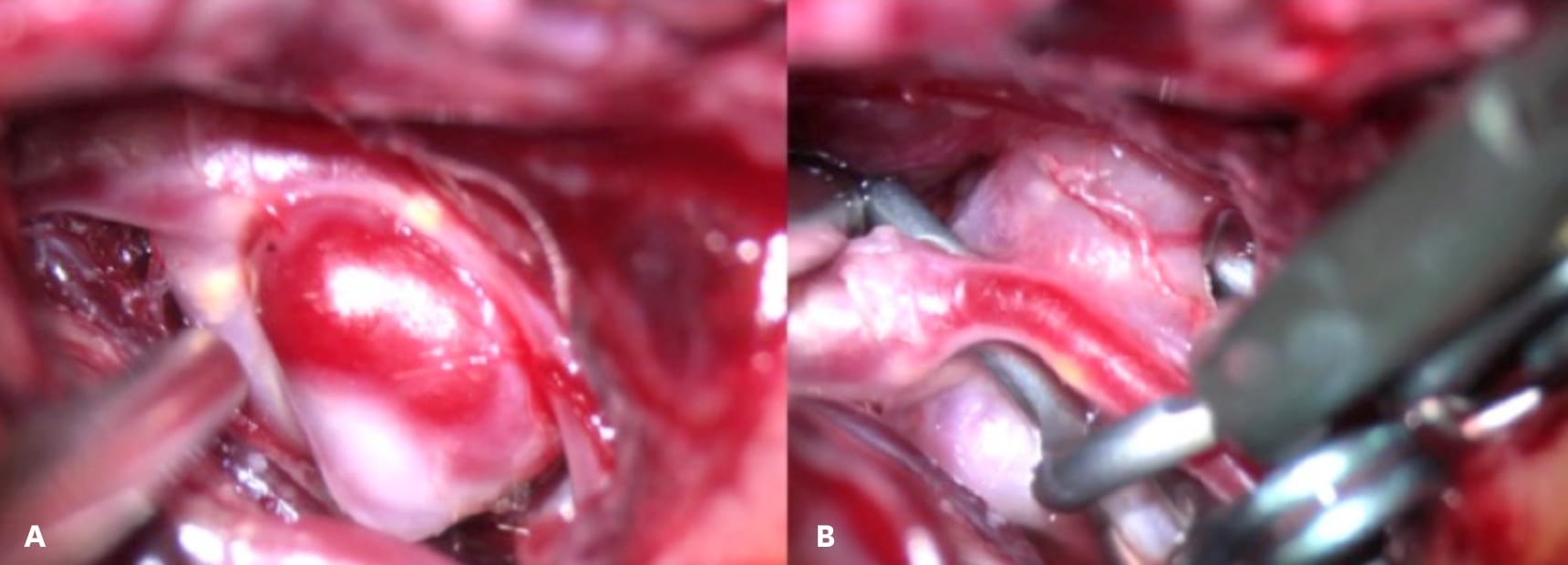 Figure 2 – (a) An intraoperative photo of an unruptured cerebral aneurysm prior to clipping. (b) An intraoperative photo of the same aneurysm during a complex clip reconstruction.