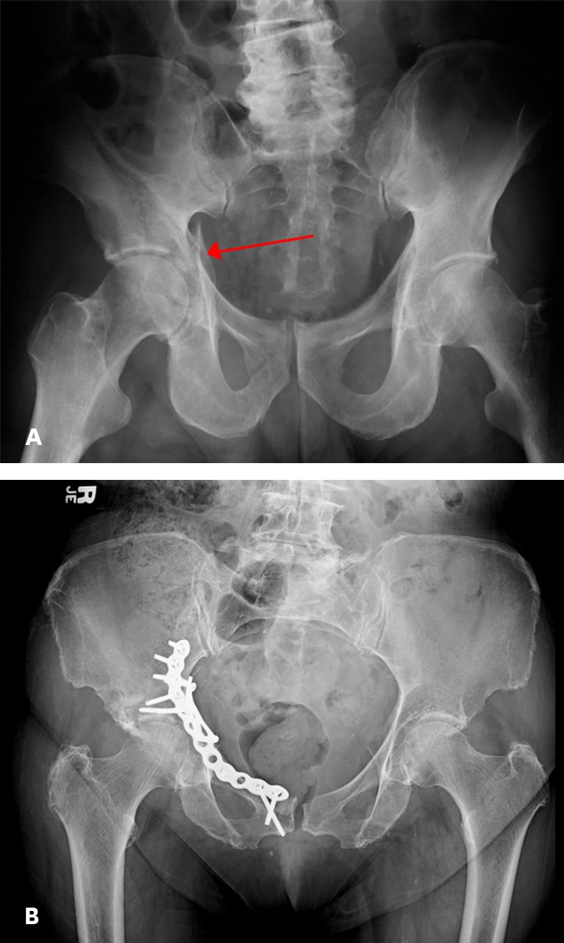 Figure A - Acetabular fracture Figure B - Acetabular fracture fixed with screws