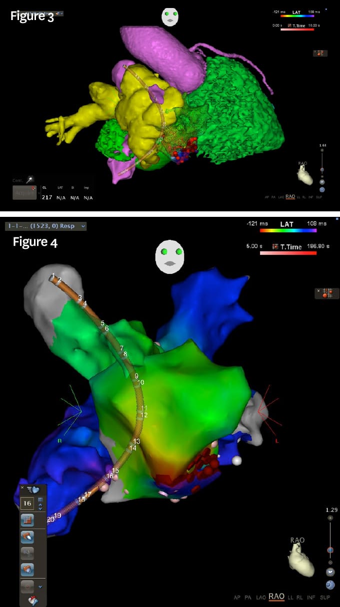 Figure 3: Images from the patient’s cardiac CT study were merged and integrated into the three-dimensional electroanatomic-mapping system, facilitating detailed anatomic and arrhythmia maps during the electrophysiology and catheter ablation procedure. Figure 4: Arrhythmia and catheter ablation map generated during the procedure. The different colors depict electrical timing sequences during the arrhythmia and the red dots designate the sites of ablation energy delivery for definitive treatment of the arrhythmia.