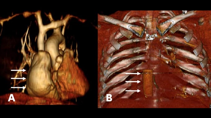 Figure 5. Left Panel: Preoperative magnetic resonance angiogram (a) demonstrating the chronic sequelae“of a classic” atriopulmonary Fontan operation in which the massively enlarged right atrium (arrows) serves an inefficient conduit for blood flow to the lungs. (b) Fontan revision surgery using a GORE-TEX® graft sewn within the right atrial chamber providing a more hydrodynamic conduit (arrows).