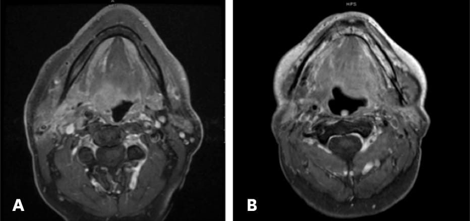 Preoperative axial MR image showing a 2.5-cm-diameter mass in the right base of the tongue (red arrow) and bilateral abnormal, enlarged lymph nodes. (a) Postoperative MR image shows that the right-side mass was totally removed using TORS. (b)
